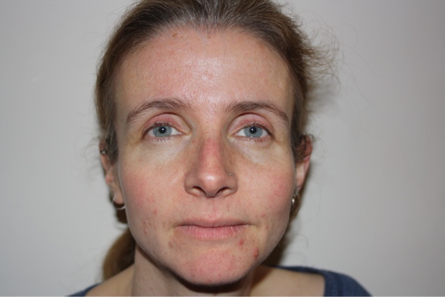 Acne solution?