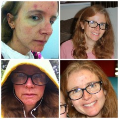 Roaccutane – spiralling out of control