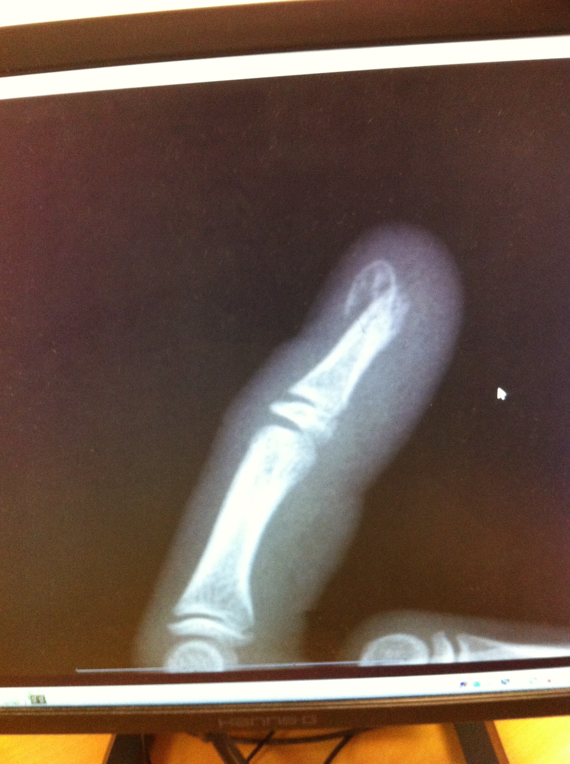 Daughter, Broken finger, Hospital, Xray