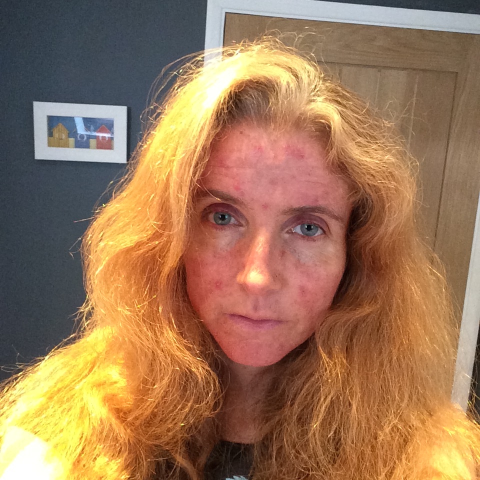 Selfie, Hair, Roaccutane